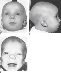 Moderate Short Stature, Facial, ± Genital