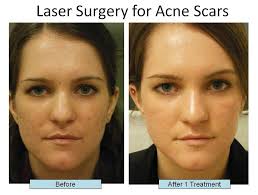 Please contact our office today to schedule your initial consultation. Acne Scar Treatments Nyc Schweiger Dermatology