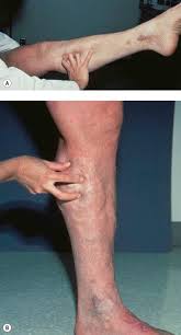 Image result for Perthes Test