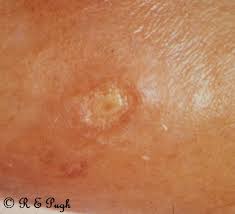 Image result for Trombicula autumnalis bites