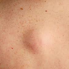 There are various ways and methods to get rid of pimples, some are natural while others toxic (use of chemical and medicine). 13 Face Bumps You Get Under Your Skin And How To Get Rid Of Them