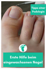 Mit Diesem Tipp Einer Podologin Kannst Du Schnell Und Effektiv Deinen Eingewachsenen Nagel Behandeln Eingewachsener Nagel Nagel Zehennagel