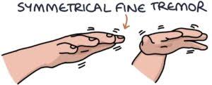 Image result for Essential Tremor