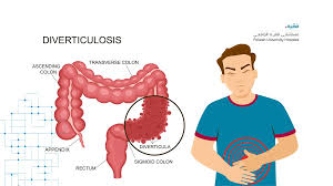 Image result for Diverticulitis