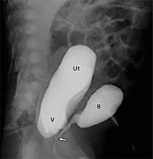 Is your child due for a vcug? Contrast Enhanced Voiding Urosonography For Vesicoureteral Reflux Diagnosis In Children Radiographics