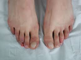 Image result for Chilblains