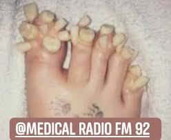 Image result for Onychogryphosis feet