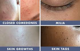 They sometimes can get confused with acne, but the difference is that the bumps never come out and stay on the skin surface if not treated. Bumps On The Skin Age Bumps Skin Growths And Clogged Pores