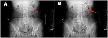 Image result for Nephrolithiasis Imaging