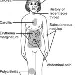 Contemporary practice is to assign a number from i to iv to a cancer, with i being an isolated cancer and iv being a cancer that has spread to the limit of what the assessment measures. Pathology Of Ovarian Tumors Quick Review Epomedicine