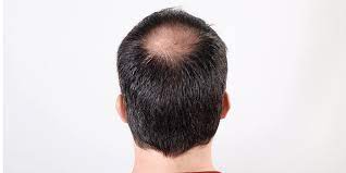 Cost estimates are based on 198 reviews submitted on realself. Prp Treatment For Hair Loss Cost And Success Rate In India 2021