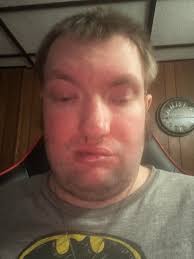 Living with keratoconus and its complications