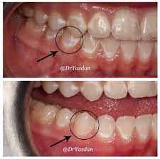 Removes harmful plaque · reverses gingivitis White Spots What They Are And How To Get Rid Of Them Center For Restorative Cosmetic Dentistry