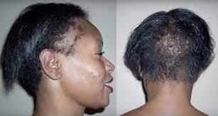 Dht affects your hairline by miniaturizing hair follicles, causing the hairs to stop growing as they normally would and eventually fall out. 7 Ways To Grow Your Edges Back And Treat A Thinning Hairline Naturallycurly Com