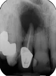 Cyst Radicular Springerlink
