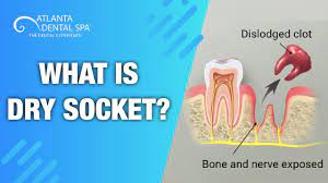 How long is your healing process postponed? What Is Dry Socket Top Dentist Says How To Prevent It Atlanta Dental Spa 2019 Youtube
