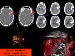 Aneurysma Gehirn 1 Youtube