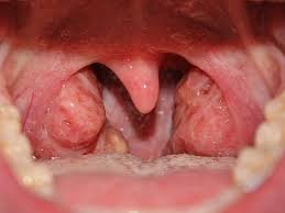 Hpv oral and oropharyngeal cancers are harder to discover than tobacco related cancers because a sensation that things are sticking in the throat when swallowing. Cdc Top Hpv Associated Cancer Is Now Oropharyngeal