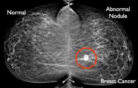 Whether you're getting a screening mammogram or a diagnostic mammogram, the basic procedure is the same. Beneath The Surface A Guide To Breast Imaging Breast360 Org The American Society Of Breast Surgeons Foundation