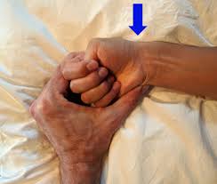 De Quervain Syndrome Wikipedia