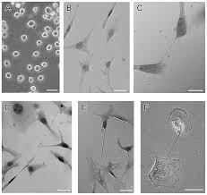 Histopathologically, a biopsy specimen from the retroperitoneal tumor revealed a biphasic type of malignant mesothelioma. Plos One Tunneling Nanotubes Provide A Unique Conduit For Intercellular Transfer Of Cellular Contents In Human Malignant Pleural Mesothelioma