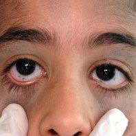 Image result for nevus sclerae