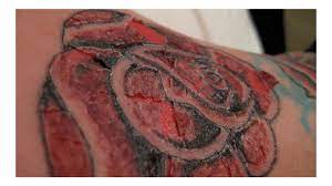 Laser tattoo removal is not linked to skin cancer. Can Tattoos Cause Cancer The Health Risks Of Inking