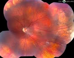 Explore more on norrie disease below! Norrie Disease