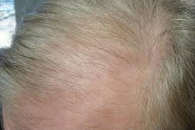 The hair propranonol induced hair loss is far more intense than the thyroid induced hair loss for sure (it also depends how far along your thyroid issues got prior to treatment because the thyroid hair loss cames like 6 months after my diagnosis in dec 2017). Drug Induced Alopecia Basicmedical Key