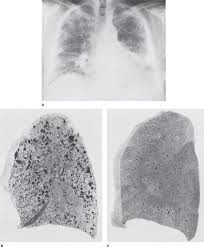 Image result for Pulmonary Intoxicant