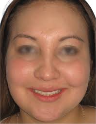 Bichectomía en Bogotá