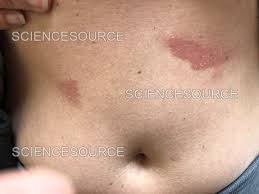 Image result for Photodermatitis