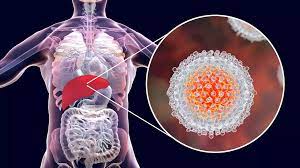 Hepatitis b is a serious liver infection that causes inflammation (swelling and reddening) that can lead to liver damage. Screening Auf Hepatitis B Und C Neu Im Gesundheits Check Up Quintessenz Verlags Gmbh