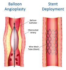 Clogged neck blockage is a dreadful condition, wherein the supply of blood to the brain is affected. Carotid Artery Surgery In Spring Hill Fl To Help Prevent Stroke