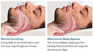 There are serious causes of snoring like obstructive sleep apnea. What Are Some Methods Proven To Reduce Or Completely Stop Snoring Quora