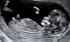 What happens at a pregnancy dating scan? Ultrasoundpartners