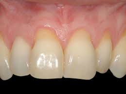 How To Grow Back Receding Gums Naturally Stethnews Grow Back Receding Gums Gum Disease Treatment Gum Disease