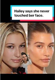 What Happened to Hailey Bieber Face