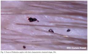 Head lice eggs are notoriously hard to remove as they are glued to the hairs. Lousology 101 Understand Louse And Nits Headlice Org