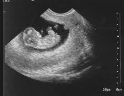 Correct dating scan at 4 weeks pregnant with my ultrasound dating scan today. What Happens At The 8 Week Ultrasound Your Fertility Friend