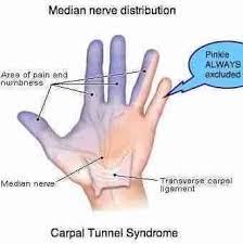 Pin On Carpal Tunnel Syndrome