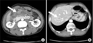 Additionally, when performing a ct scan with intravenous. Abdominal Ct Scan A Ct Scan Showed Contrast Enhancement Of The Tumor Download Scientific Diagram