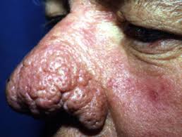 Entdecke rezepte, einrichtungsideen, stilinterpretationen und andere ideen zum ausprobieren. Rosacea Dermnet Nz