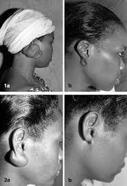| ❄ lilith whitic ❄. A This Mold Of Earlobe Keloid Before Triple Therapy B Result After Download Scientific Diagram