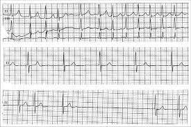 In this post we have shared all a rapid and irregular heart beat word tower crosswords answers. Telemetry Strips Showing Atrial Fibrillation With Rapid Ventricular Download Scientific Diagram