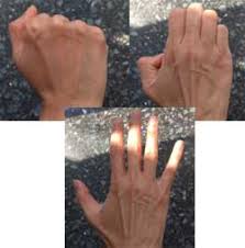 There is some evidence supporting the use of exercise — such as minor strength training. Preventing Injury 8 Best Hand And Wrist Exercises For Computer Users Ergonomic Trends