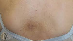 Image result for Notalgia Paresthetica