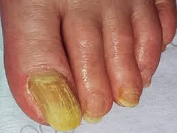 Image result for Yellow nail syndrome feet