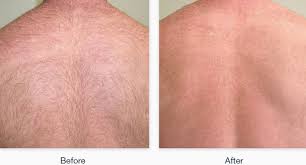 St james is a well established beauty salon in central london, based in victoria sw1, and is close to st james's and westminster. Laser Hair Removal Richmond Surrey