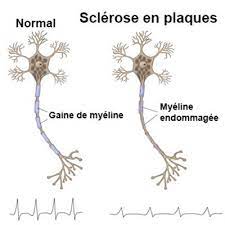 Lire le grand livre des symboles reiki : Sclerose En Plaque Symptomes Traitement Definition Docteurclic Com